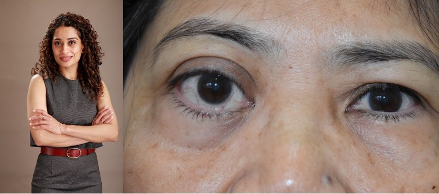 Eye tumor larger than an eyeball in size, surgically removed to help Filipina expat regain vision at Medcare Hospital&nbsp;Sharjah