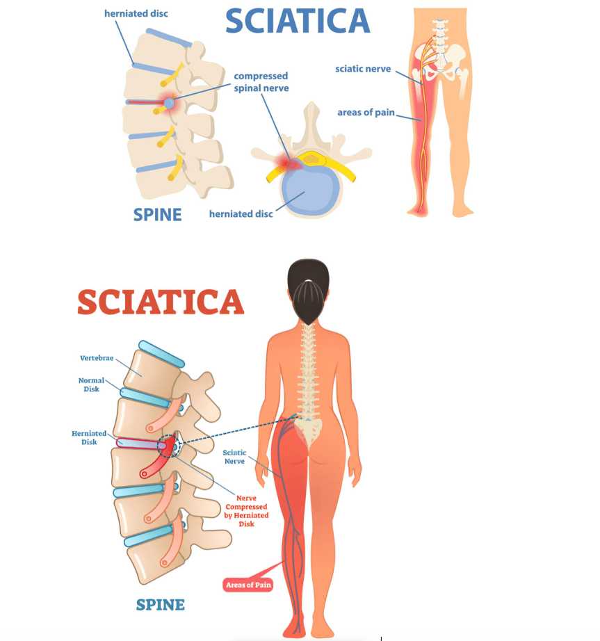 Breaking Free from Sciatica: How Physiotherapy Changes&nbsp;Lives